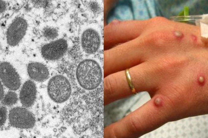 Belgique: Premières quarantaines obligatoires pour la variole du singe
